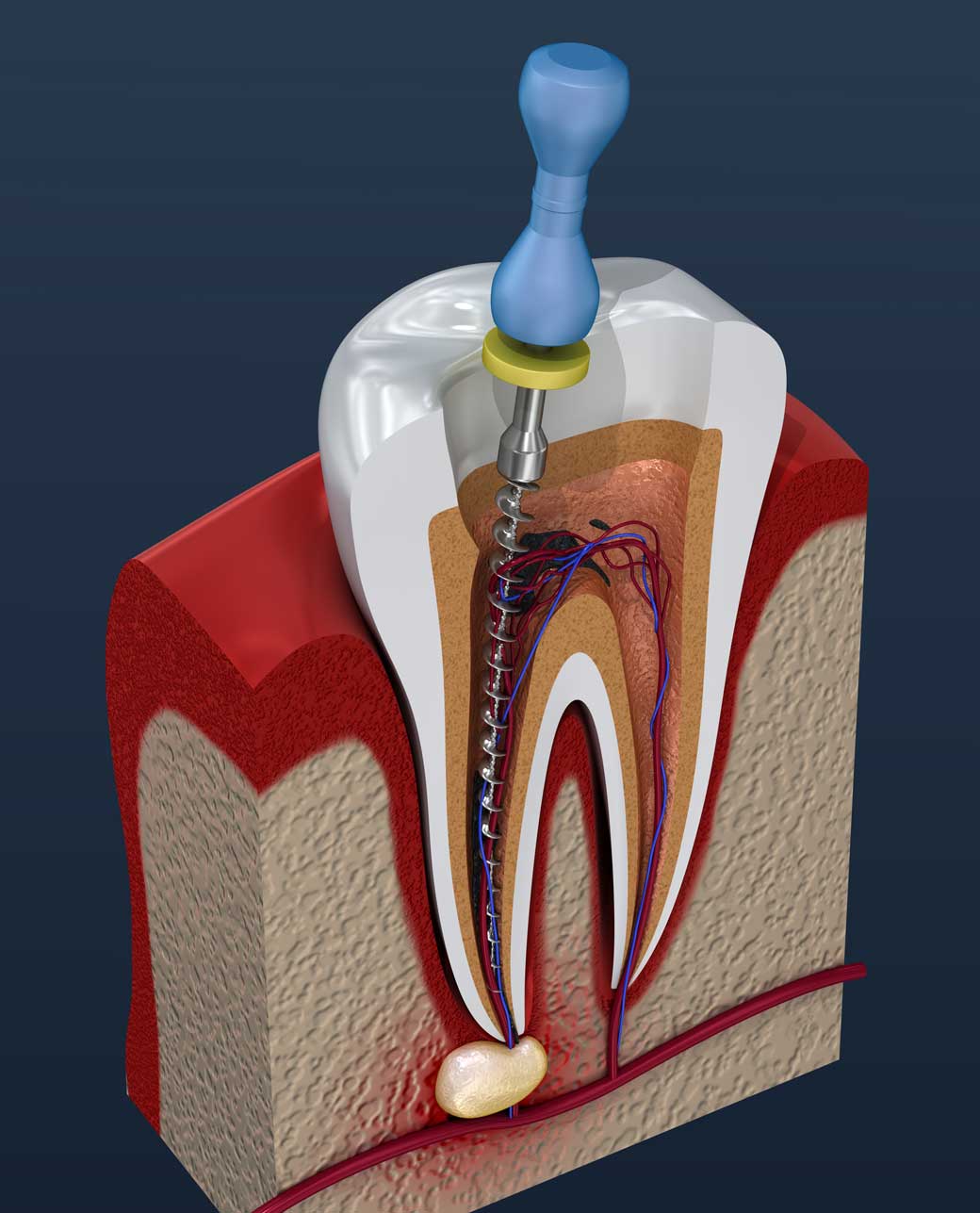 Root canal model